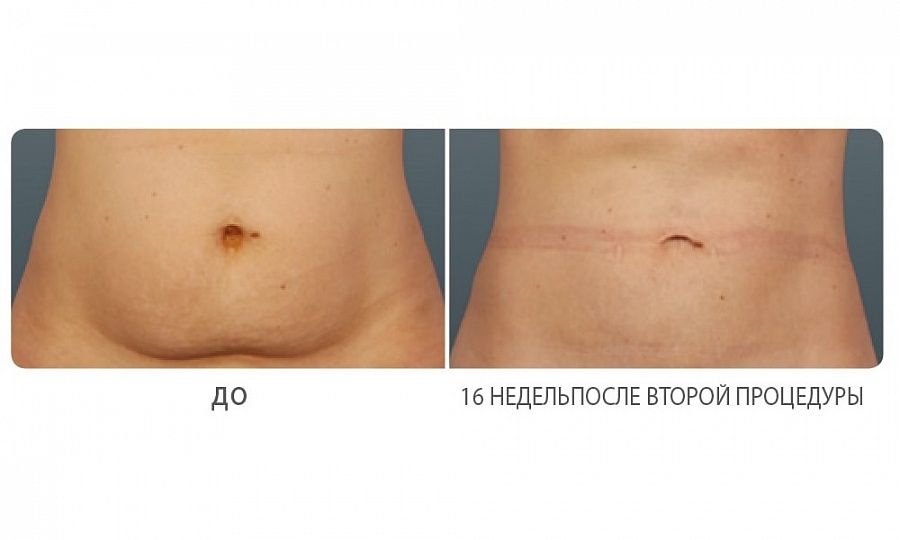 Криолиполиз Coolsculpting – фигура мечты за 1 сеанс - фото №2