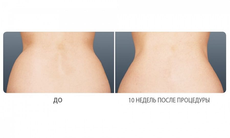 Криолиполиз Coolsculpting – фигура мечты за 1 сеанс - фото №5